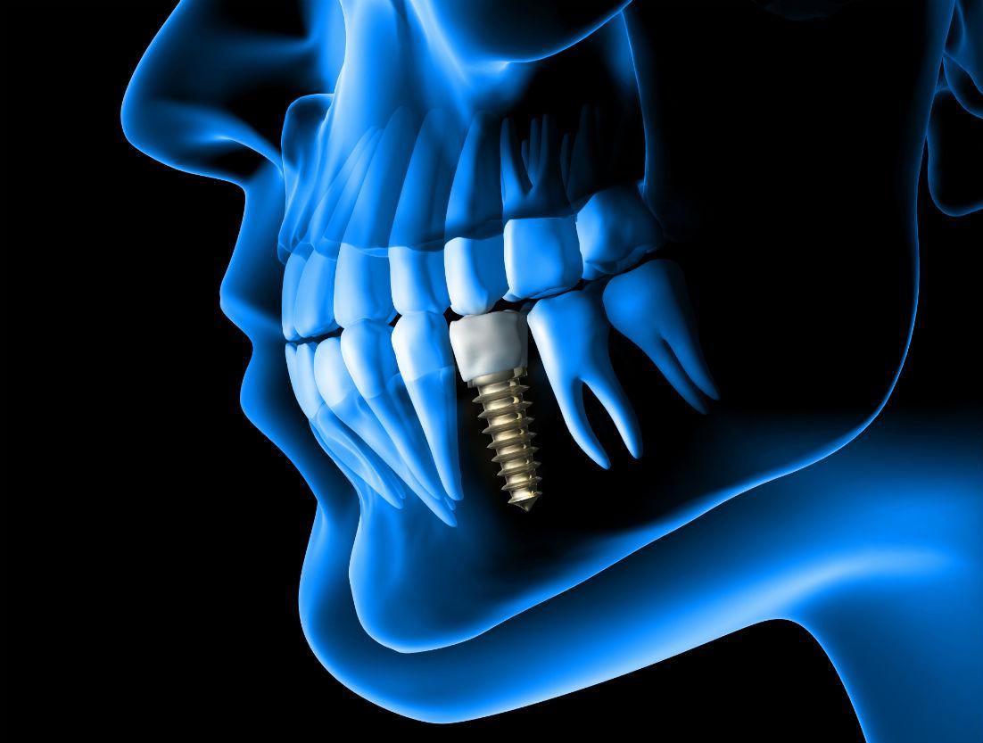 Dental Implants Nashua, NH