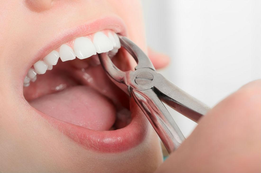 Tooth Extraction Nashua, NH